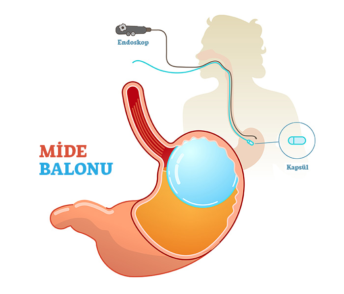 Mide Balonu Nedir? Nasıl Uygulanır? - Mide Balonu Fiyatları